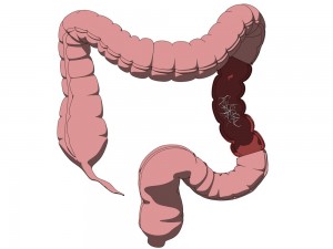 Parazitozele intestinale la copii