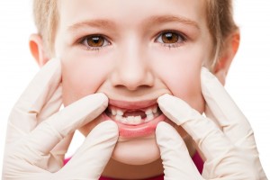 Edentația (lipsa dinților) la copii